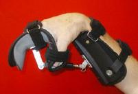 Turnbuckle Wrist Orthosis